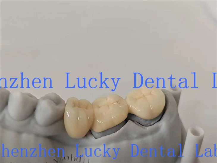 3D Print Pfm Cocr Dental Bridge med Post Core Dental Lab